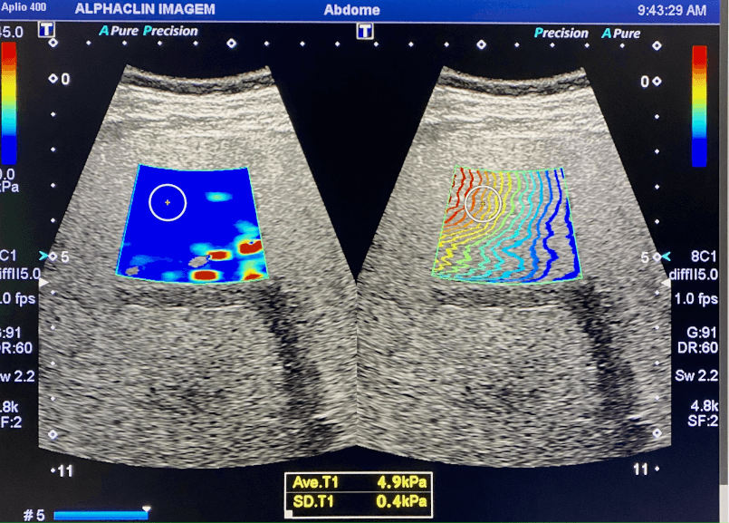 tela-elastografia.png